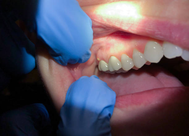 Best Emergency Dentist for Lost Fillings or Crowns in Webster, SD